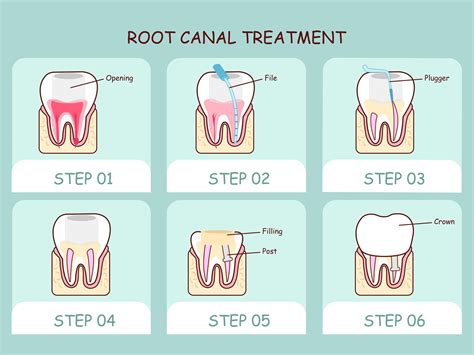 Failed Root Canal Bleeding