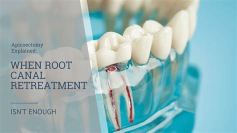 Failed Root Canal Retreatment