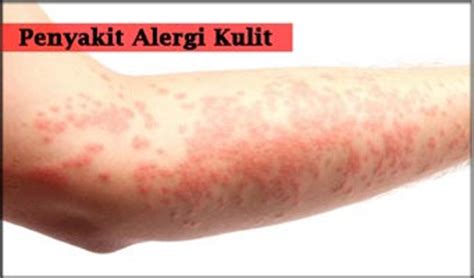 Faktor Penyebab Gatal Alergi