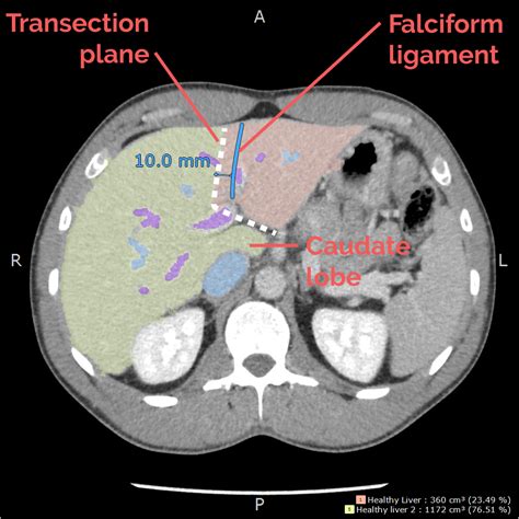 falciform ligament on ct