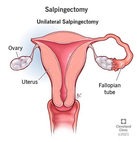 Understanding Fallopian Tube Removal: Risks, Benefits, and What to Expect