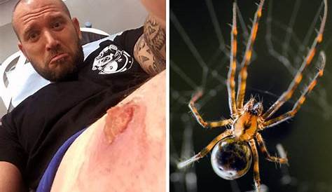 False Black Widow Spider Bites Bite Gets Infected Somerset Live