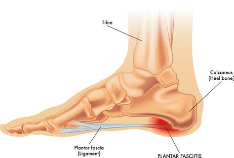 What Is Plantar Fasciitis?