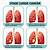 fases de cancer de pulmon