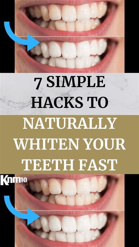 Fast Teeth Whitening Tricks