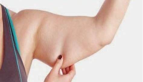 Fat Upper Arms Thyroid Lose Arm With CoolSculpting London & Bucks Non