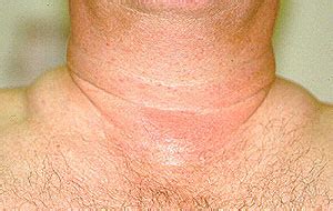fat pads at base of neck