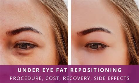 fat repositioning under eye
