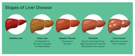 fatty liver vs cirrhosis
