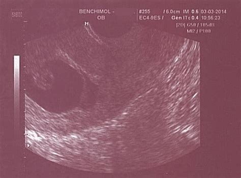 Qu’est-Ce Qu’un Oeuf Clair Et Quels Sont Ses Signes ?