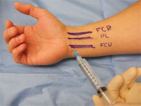 fcr tendon injection
