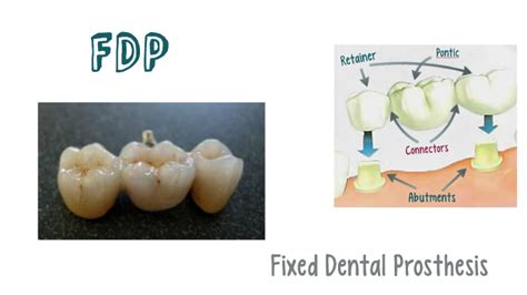 fdp in dentistry