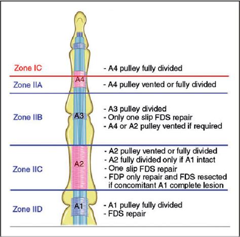 fds and fdp tendon repair protocol