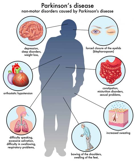 features of parkinson's disease