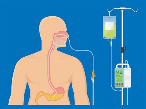 feeding tube for esophageal cancer patients