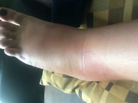 Feet Sting When Walking