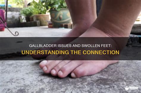 Feet Swelling Gallbladder
