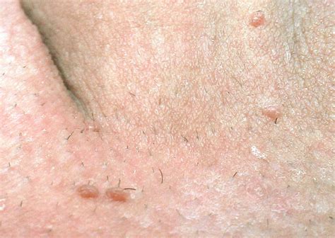 feigwarzen selbsttest