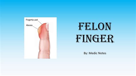 Understanding the Rare Condition of Felon of Finger Infection