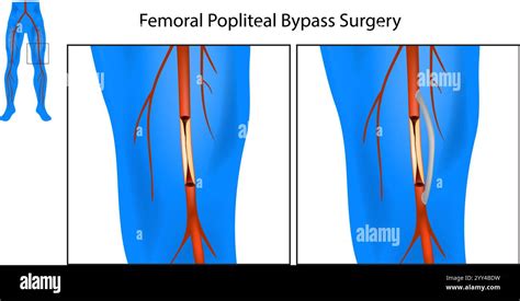 Understanding Femoral Pop Bypass: What You Need to Know About This Critical Vascular Procedure