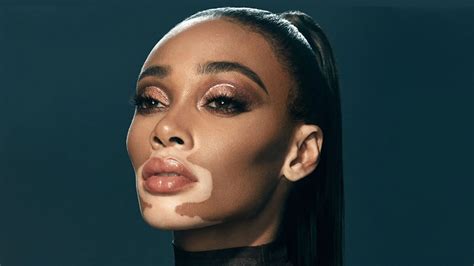 female celebrities with vitiligo