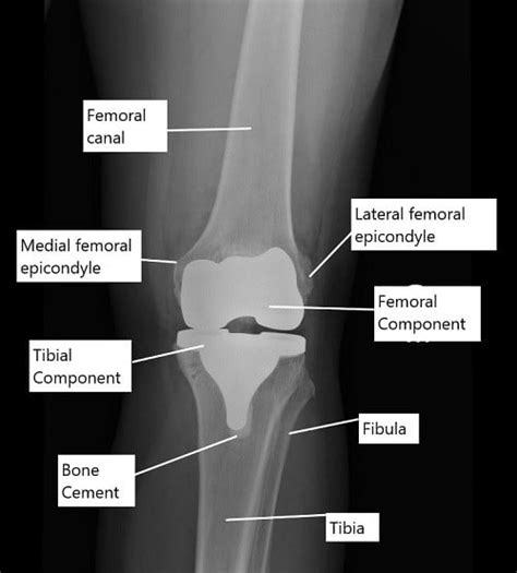 Female Knee Joint Replacement