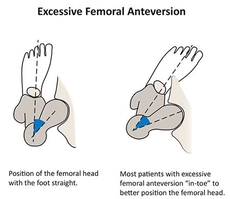 Femoral Anteversion Physiotherapy Treatment