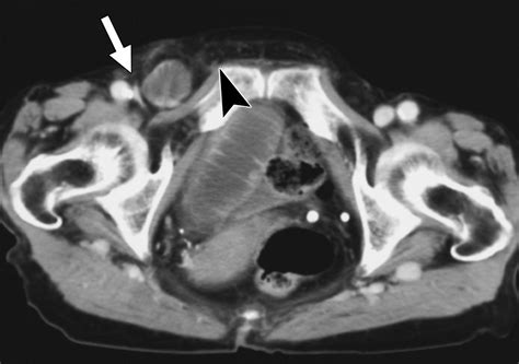 femoral vs inguinal hernia radiology