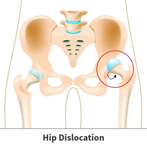 Femur Hip Joint Dislocation