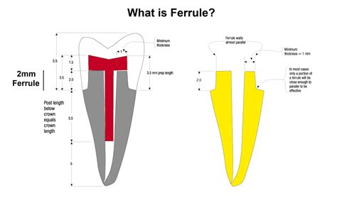ferrule definition in dentistry