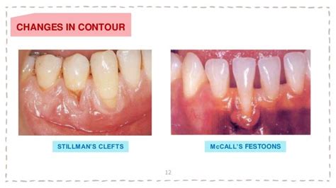 Festooned Gum Tissue