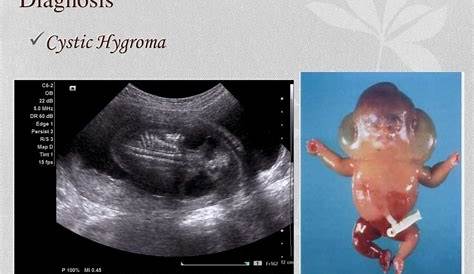 Cystic hygroma with hydrops fetalis Image