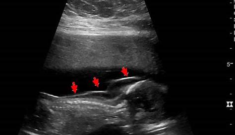 Fetal Cystic Hygroma Prognosis Ultrasound Image Of A Septated Which