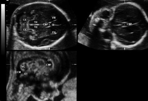 fetal head ultrasound images