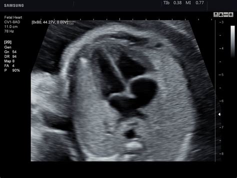 fetal heart sonogram