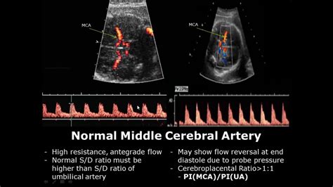 fetal middle cerebral artery