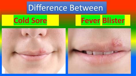 Fever Blister vs Cold Sore: What's the Difference and How to Tell Them Apart