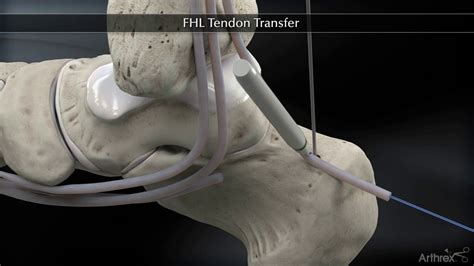 fhl tendon transfer protocol