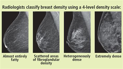 Understanding Fibroglandular Density Breast: What You Need to Know About This Common Condition