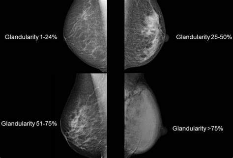 Understanding Fibroglandular Density in Breast for Better Health Outcomes