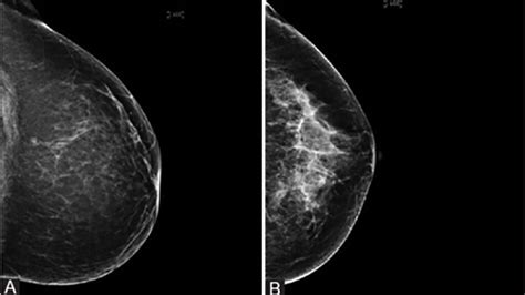 Understanding Fibroglandular Tissue in Breasts: What You Need to Know About Its Impact on Health and Imaging