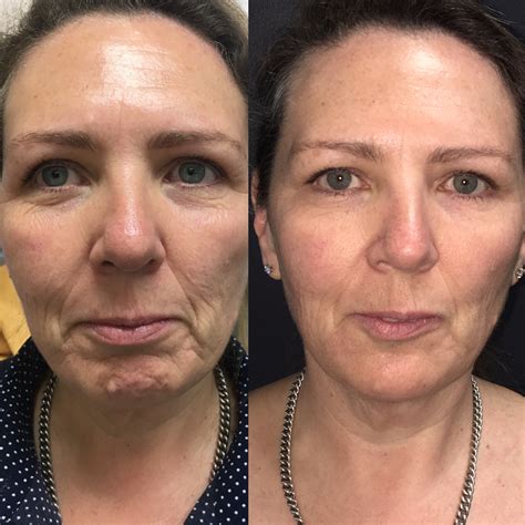Filler for Cheeks, Chin, Lines (PreJowl Sulcus