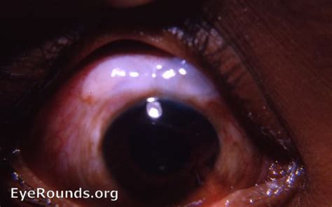 Filtering Bleb After Glaucoma Surgery