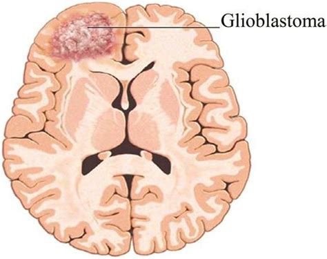 final stages of glioblastoma