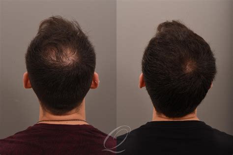 Regain Your Crowning Glory: Unraveling the Power of Finasteride + Minoxidil for Hair Restoration