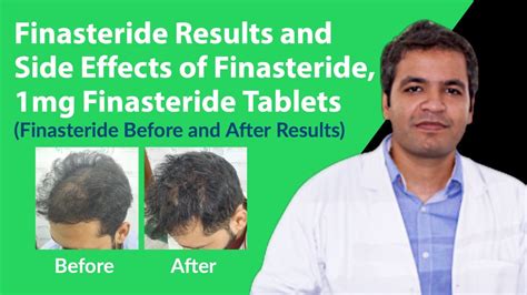 finasteride 1mg before and after