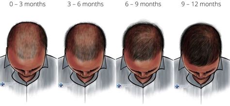 finasteride 1mg timeline