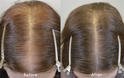 finasteride 5mg for women's hair loss