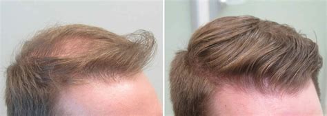 finasteride and body hair