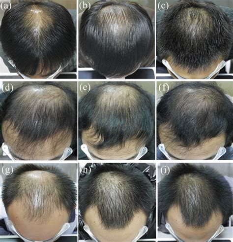 finasteride and hair growth